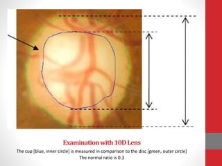 Examinationwith10DLens
The cup [blue, inner circle] is measured in comparison to the disc [green, outer circle]
The normal ratio is 0.3
 