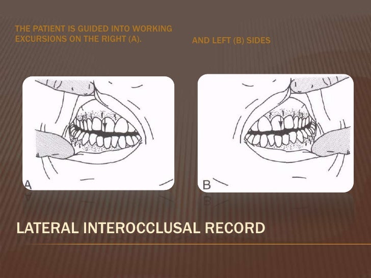 dr vafaee shlinberg interocclusal records