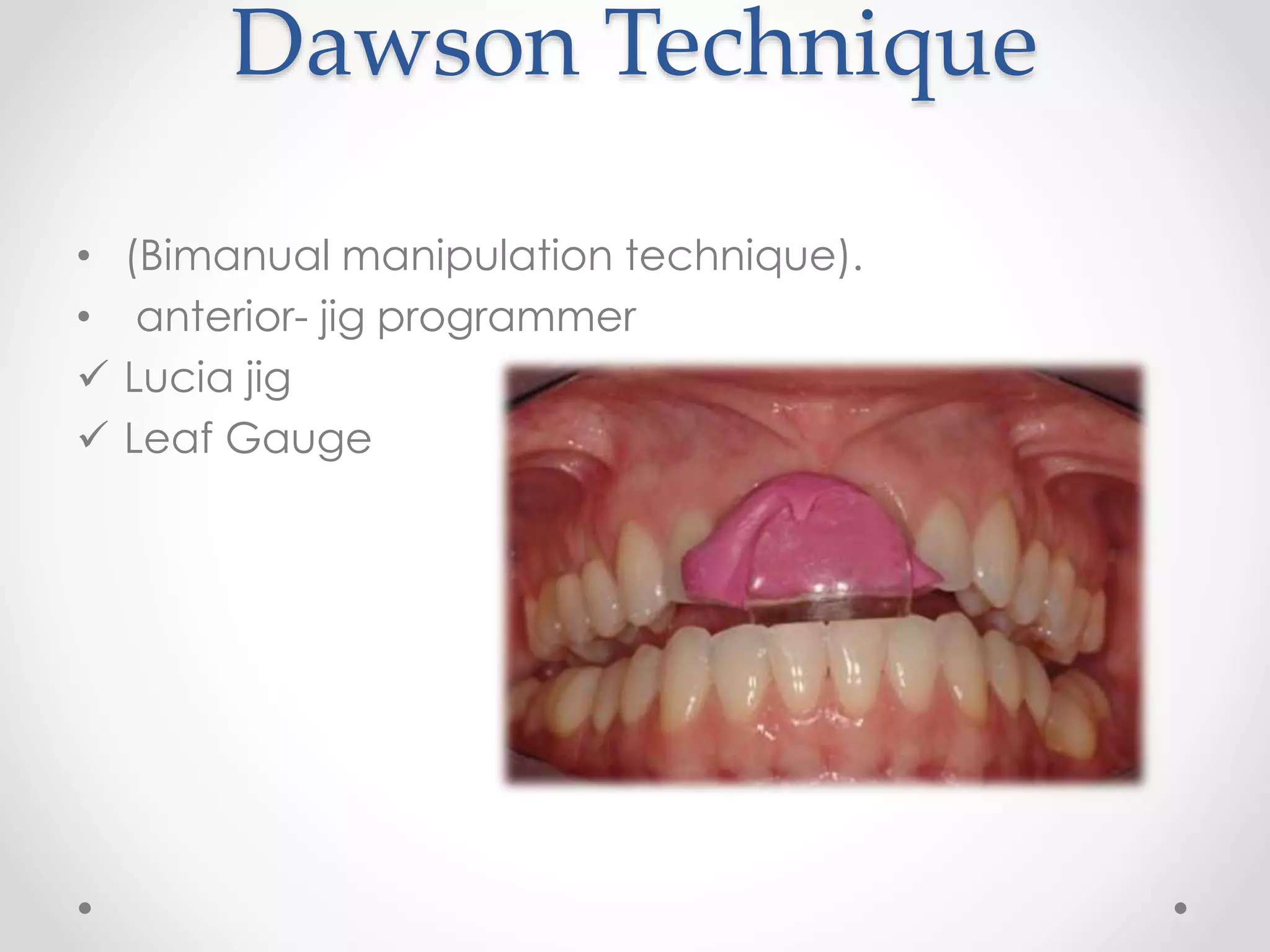 bite registration for fixed Prosthodontic restoration PPT