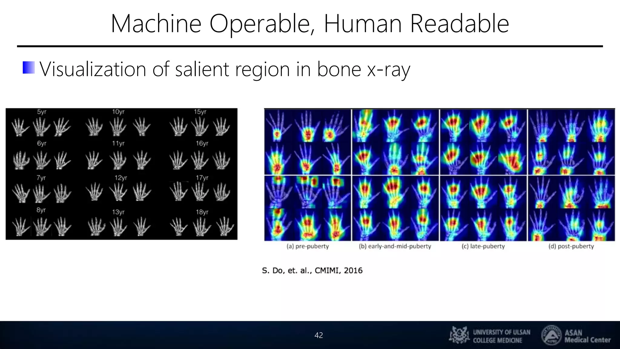 Machine Operable, Human Readable
Visualization of salient region in bone x-ray
42
 