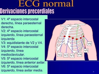 11
V1: 4º espacio intercostal
derecho, línea paraesternal
derecha.
V2: 4º espacio intercostal
izquierdo, línea paraesternal
izquierda
V3: equidistante de V2 y V4.
V4: 5º espacio intercostal
izquierdo, línea
medioclavicular.
V5: 5º espacio intercostal
izquierdo, línea anterior axilar.
V6: 5º espacio intercostal
izquierdo, línea axilar media.
 