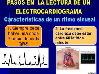 24
1. Siempre debe
haber una onda
P antes de cada
QRS
2. La frecuencia
cardiaca debe estar
entre 60 latidos
minuto
 