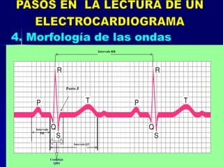Intervalo
PR
Complejo
QRS
Intervalo RR
Punto J
Intervalo QT
 