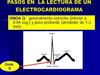 ONDA Q: generalmente estrecha (inferior a
0.04 seg.) y poco profunda (alrededor de 1-2
mm).
Onda
Q
 