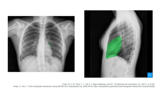 Interpretación de Radiografía de Tórax.. | PPTX