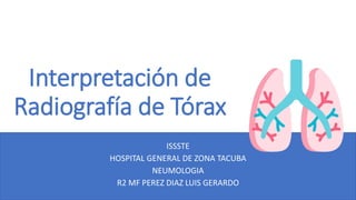 Interpretación de
Radiografía de Tórax
ISSSTE
HOSPITAL GENERAL DE ZONA TACUBA
NEUMOLOGIA
R2 MF PEREZ DIAZ LUIS GERARDO
 