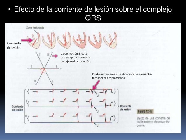 Resultado de imagen para corriente de lesion electrocardiograma