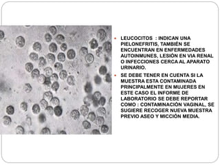  LEUCOCITOS : INDICAN UNA
PIELONEFRITIS, TAMBIÉN SE
ENCUENTRAN EN ENFERMEDADES
AUTOINMUNES, LESIÓN EN VIA RENAL
O INFECCIONES CERCA AL APARATO
URINARIO.
 SE DEBE TENER EN CUENTA SI LA
MUESTRA ESTA CONTAMINADA
PRINCIPALMENTE EN MUJERES EN
ESTE CASO EL INFORME DE
LABORATORIO SE DEBE REPORTAR
COMO : CONTAMINACIÓN VAGINAL, SE
SUGIERE RECOGER NUEVA MUESTRA
PREVIO ASEO Y MICCIÓN MEDIA.
 