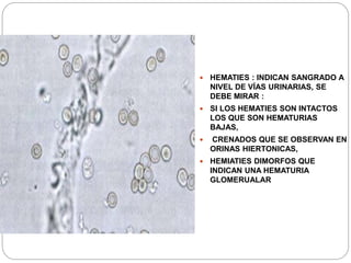  HEMATIES : INDICAN SANGRADO A
NIVEL DE VÍAS URINARIAS, SE
DEBE MIRAR :
 SI LOS HEMATIES SON INTACTOS
LOS QUE SON HEMATURIAS
BAJAS,
 CRENADOS QUE SE OBSERVAN EN
ORINAS HIERTONICAS,
 HEMIATIES DIMORFOS QUE
INDICAN UNA HEMATURIA
GLOMERUALAR
 