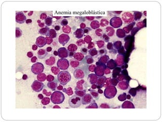 Anemia megaloblástica
 