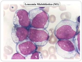 Leucemia Mieloblástica (M1)
 