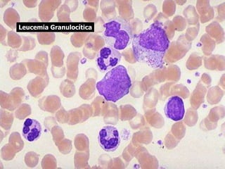 Leucemia Granulocítica
 
