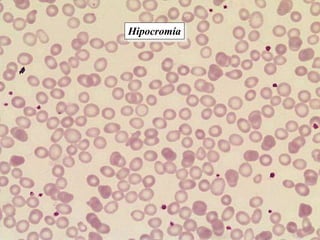 Hipocromía
 