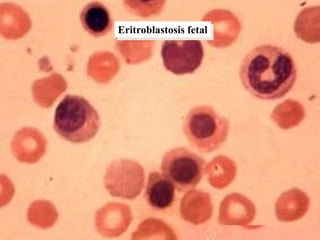 Eritroblastosis fetal
 
