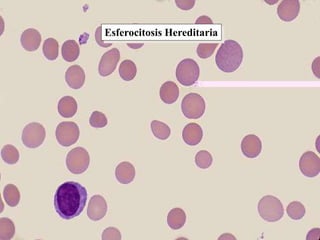 Esferocitosis Hereditaria
 