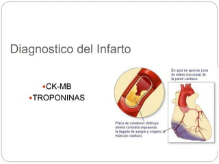 Diagnostico del Infarto
CK-MB
TROPONINAS
 