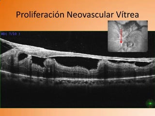 Proliferación Neovascular Vítrea
 