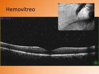 Hemovítreo
 