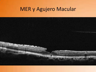 MER y Agujero Macular
 