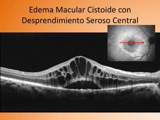 Edema Macular Cistoide con
Desprendimiento Seroso Central
 