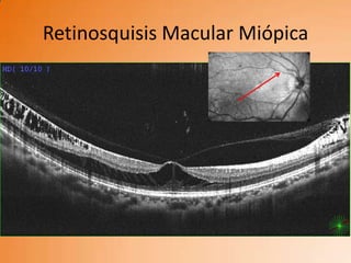 Retinosquisis Macular Miópica
 