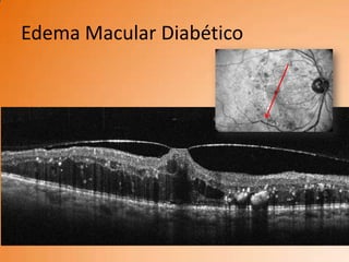 Edema Macular Diabético
 