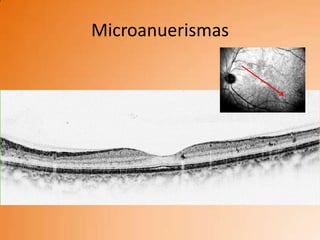 Microanuerismas
 