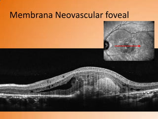 Membrana Neovascular foveal
 