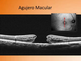 Agujero Macular
 