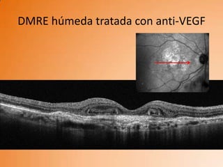 DMRE húmeda tratada con anti-VEGF
 