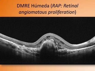 DMRE Húmeda (RAP: Retinal
 angiomatous proliferation)
 