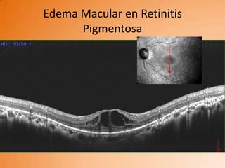 Edema Macular en Retinitis
      Pigmentosa
 
