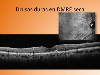 Drusas duras en DMRE seca
 