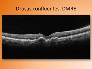 Drusas confluentes, DMRE
 
