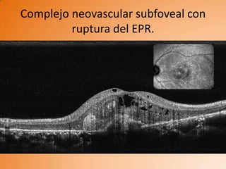 Complejo neovascular subfoveal con
         ruptura del EPR.
 