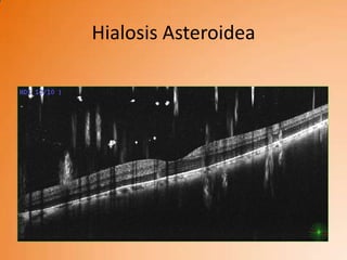 Hialosis Asteroidea
 