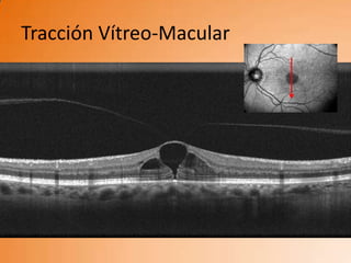 Tracción Vítreo-Macular
 