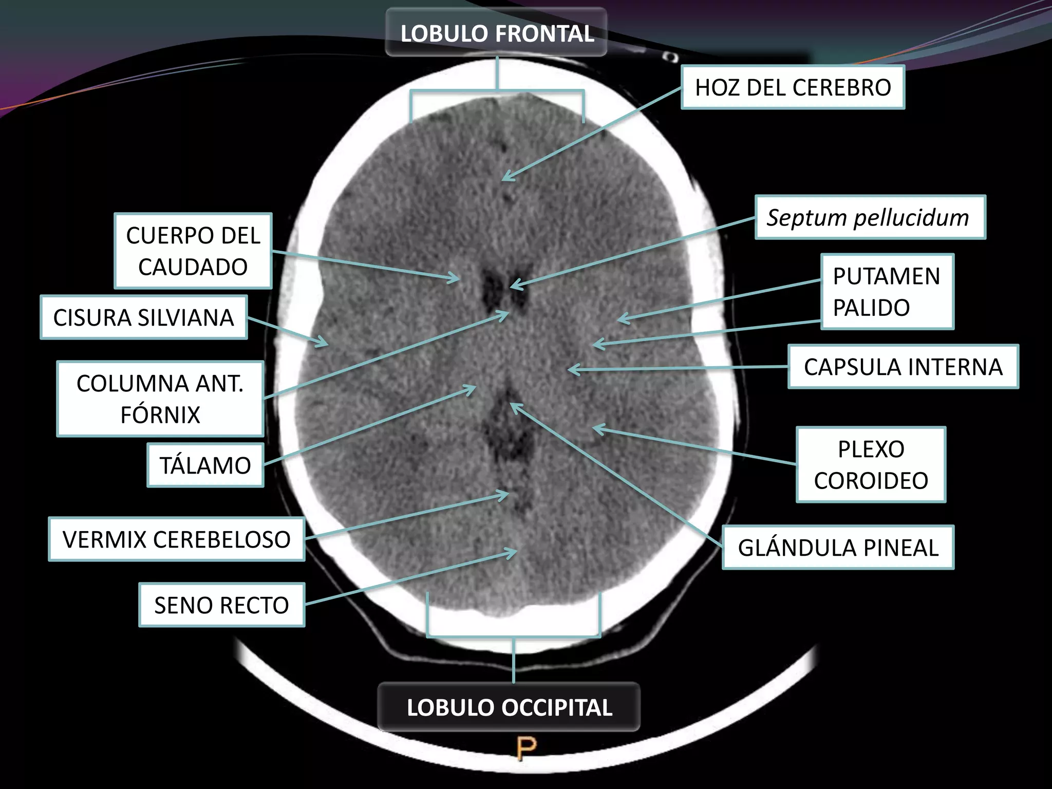 INTERPRETACION DE ANATOMIA CEREBRAL EN UNA TAC CRANEAL PPTX