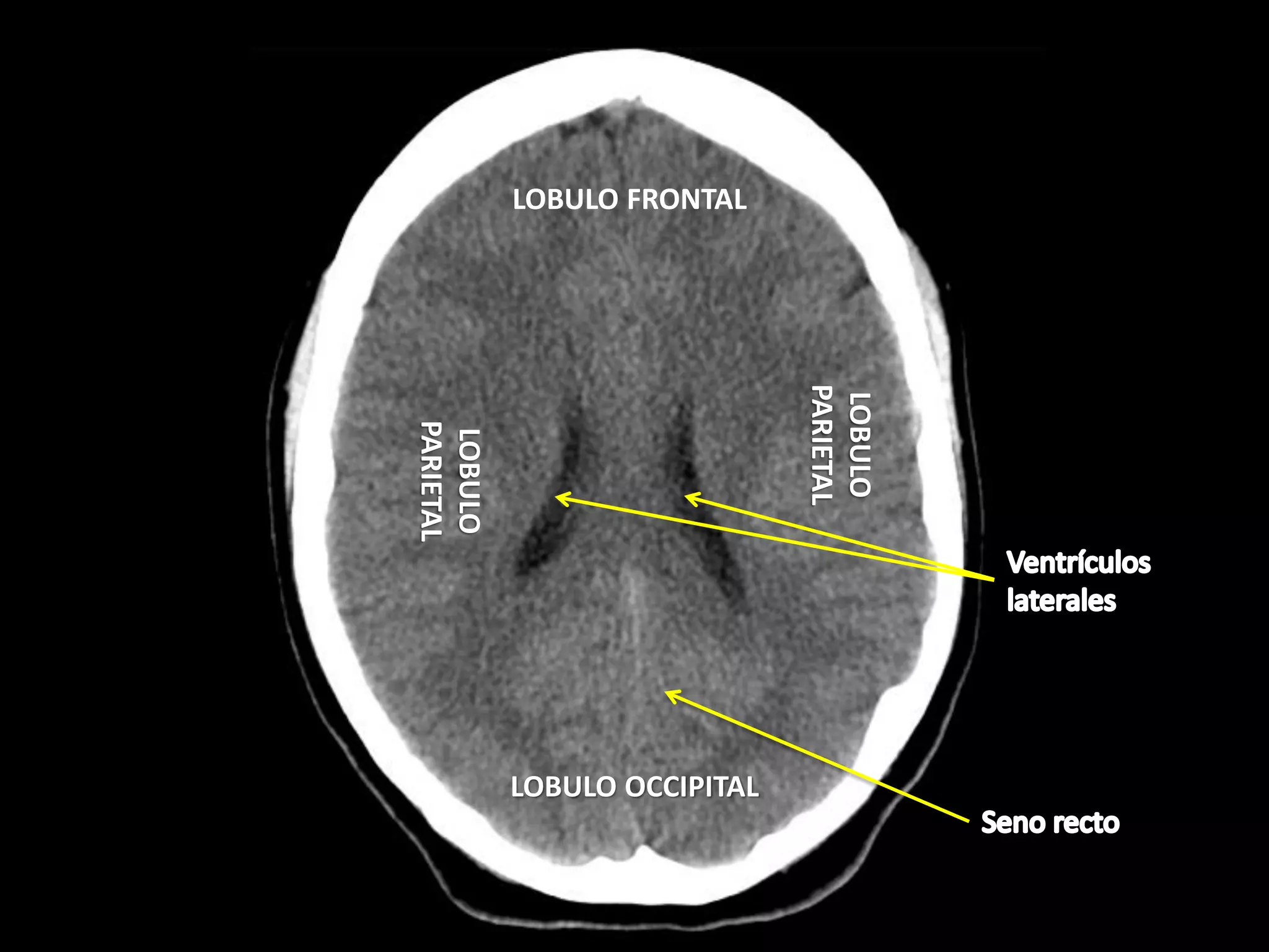 Tac Normal Interpretacion de TAC de CRÁNEO fase simple | PDF | Death, Injury, or ...