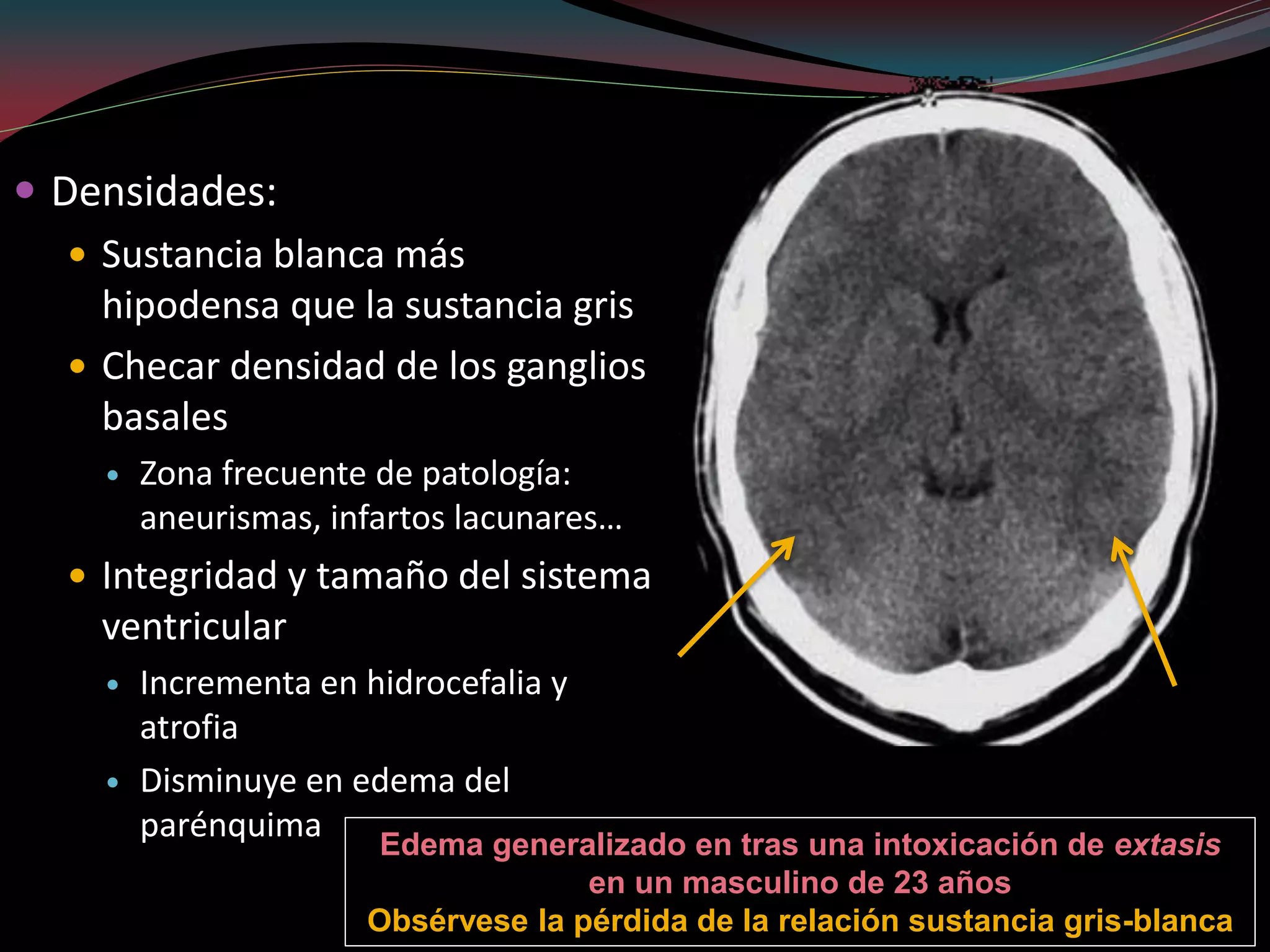 Tac Normal Interpretacion de TAC de CRÁNEO fase simple | PDF | Death, Injury, or ...