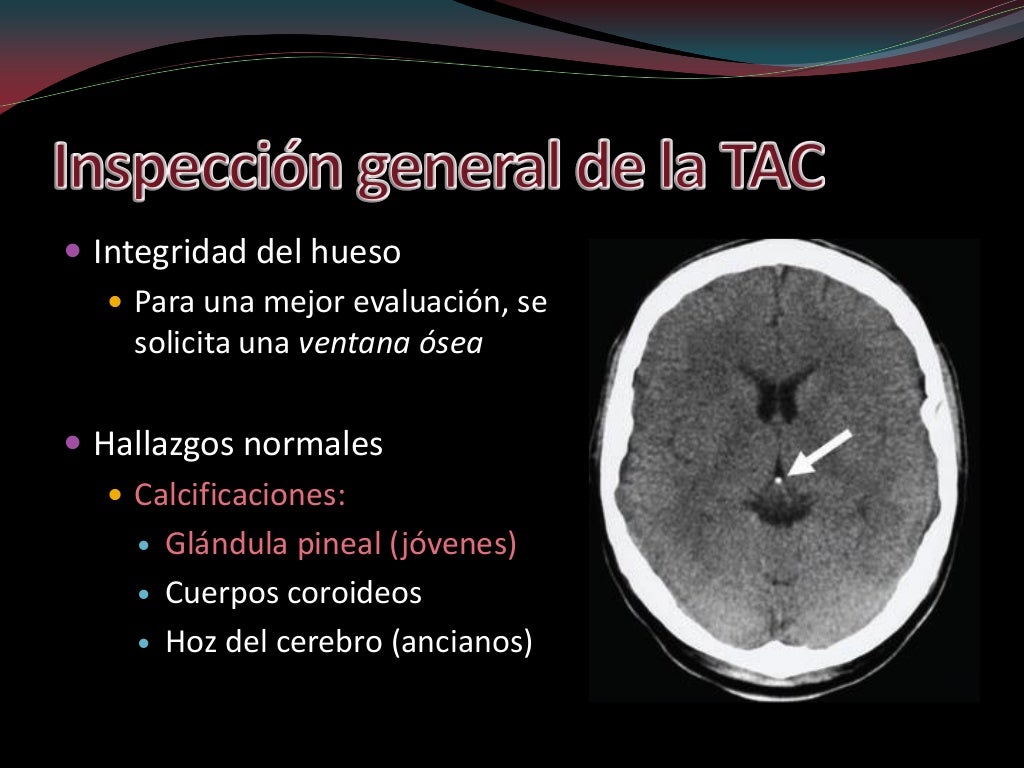 Cuanto Dura Un Tac De Cabeza Interpretacion de TAC de CRÁNEO fase simple