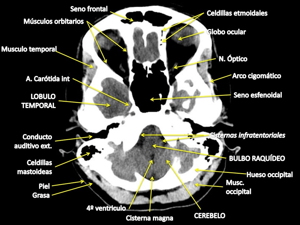 Como Interpretar Una Tac De Craneo