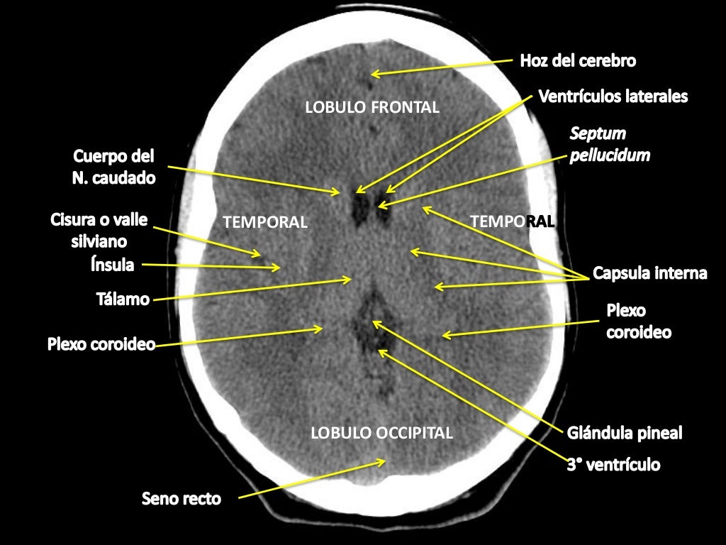 Como Interpretar Una Tac De Craneo