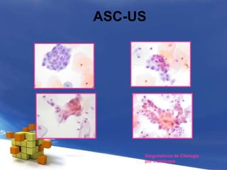 ASC-US
Diagnósticos de Citología
por monocapa
 