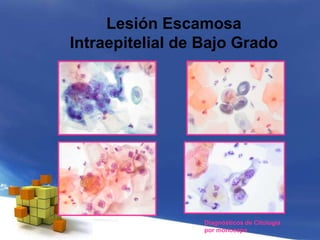 Lesión Escamosa
Intraepitelial de Bajo Grado
Diagnósticos de Citología
por monocapa
 