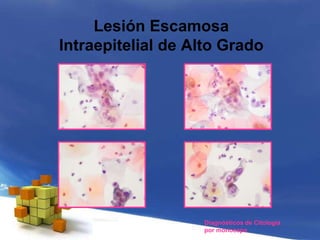 Lesión Escamosa
Intraepitelial de Alto Grado
Diagnósticos de Citología
por monocapa
 