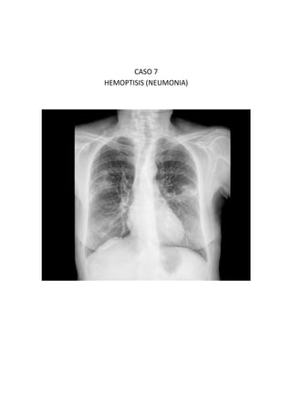 CASO 7
HEMOPTISIS (NEUMONIA)
 