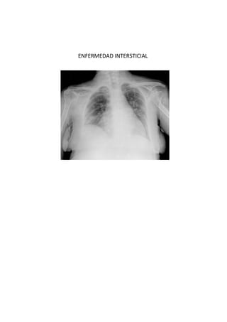 ENFERMEDAD INTERSTICIAL
 