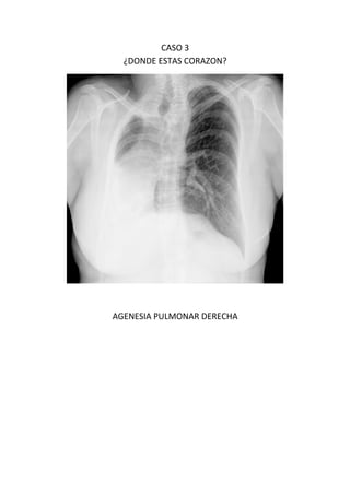 CASO 3
¿DONDE ESTAS CORAZON?
AGENESIA PULMONAR DERECHA