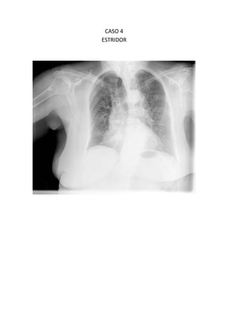 CASO 4
ESTRIDOR